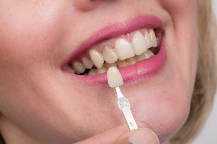 Porcelain Jacket Crowns