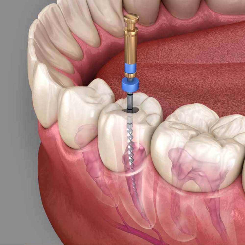 Root Canal Treatment
