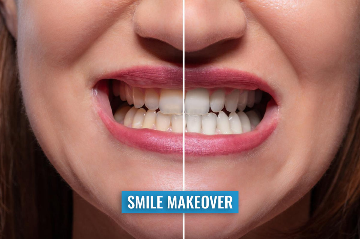 Smile Make-Overs