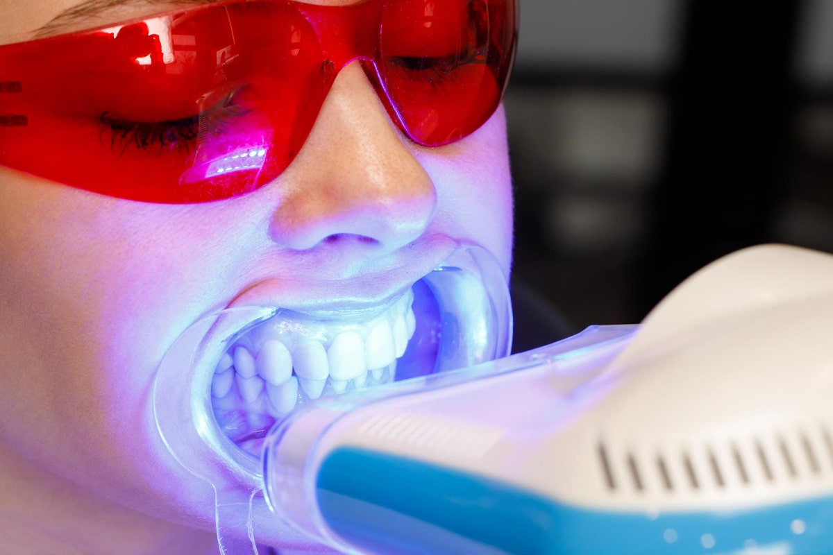 Teeth Whitening