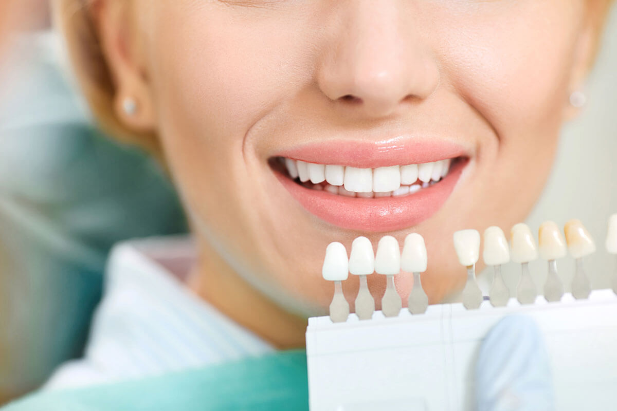 Veneers